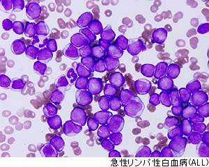 ALLの危険因子は何ですか?